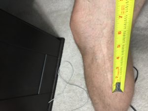 Fibular /peroneal nerve scar 